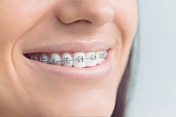 Dental Bonding in Dripping Springs, TX